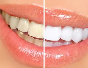 blanqueamiento-tratamientos-clinica-dental-gramadent-292×225